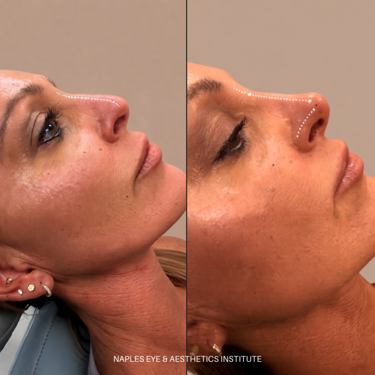 Fluid Rhinoplasty