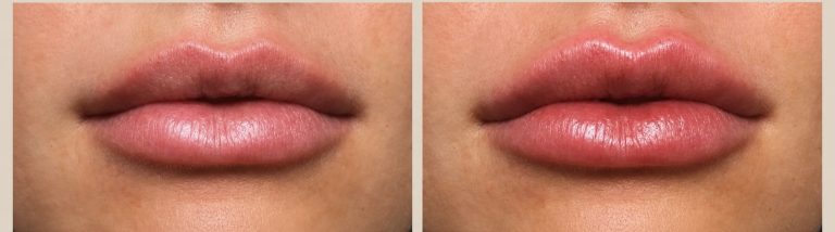 Lip Enhancement