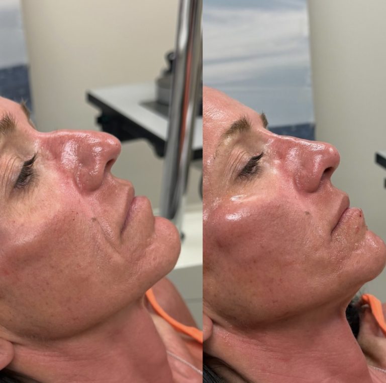 Fluid Rhinoplasty