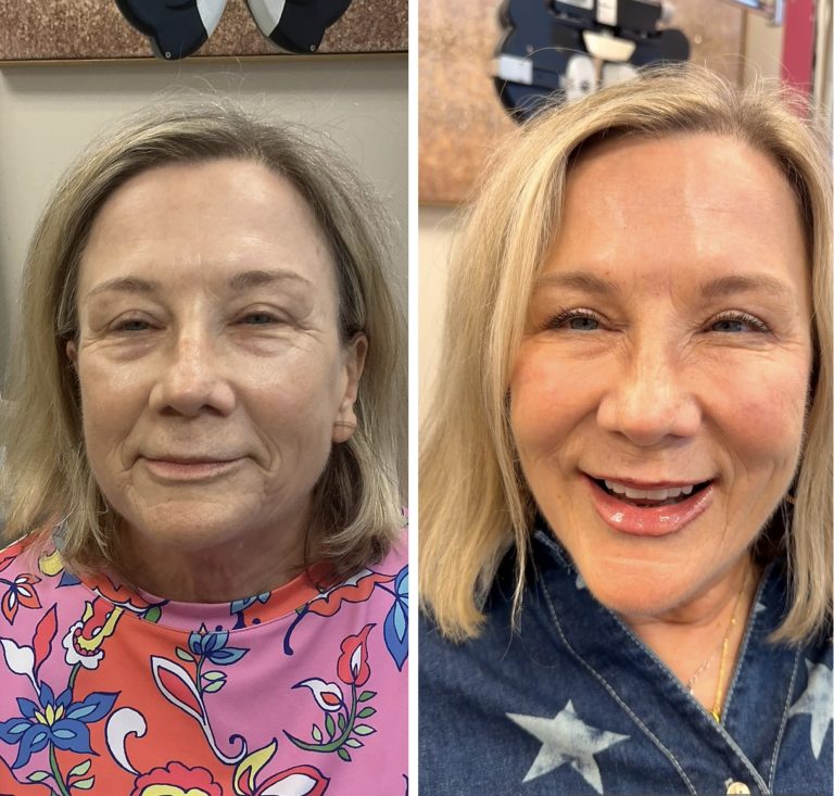 European Fluid Face Lift
