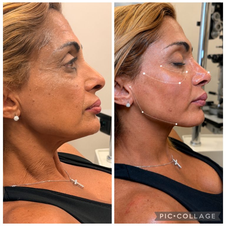 Mid-Face Lift