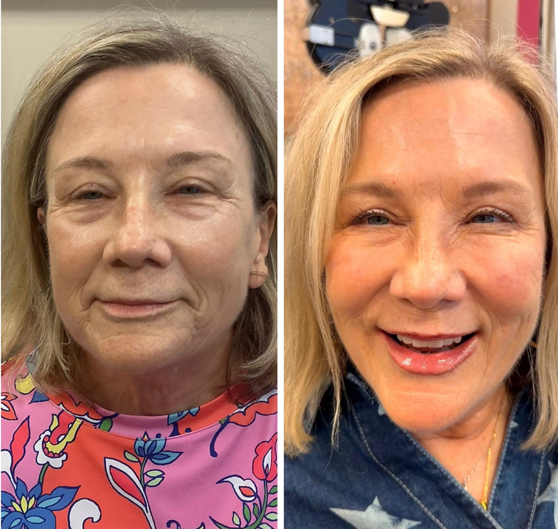 Before and After - Patient result