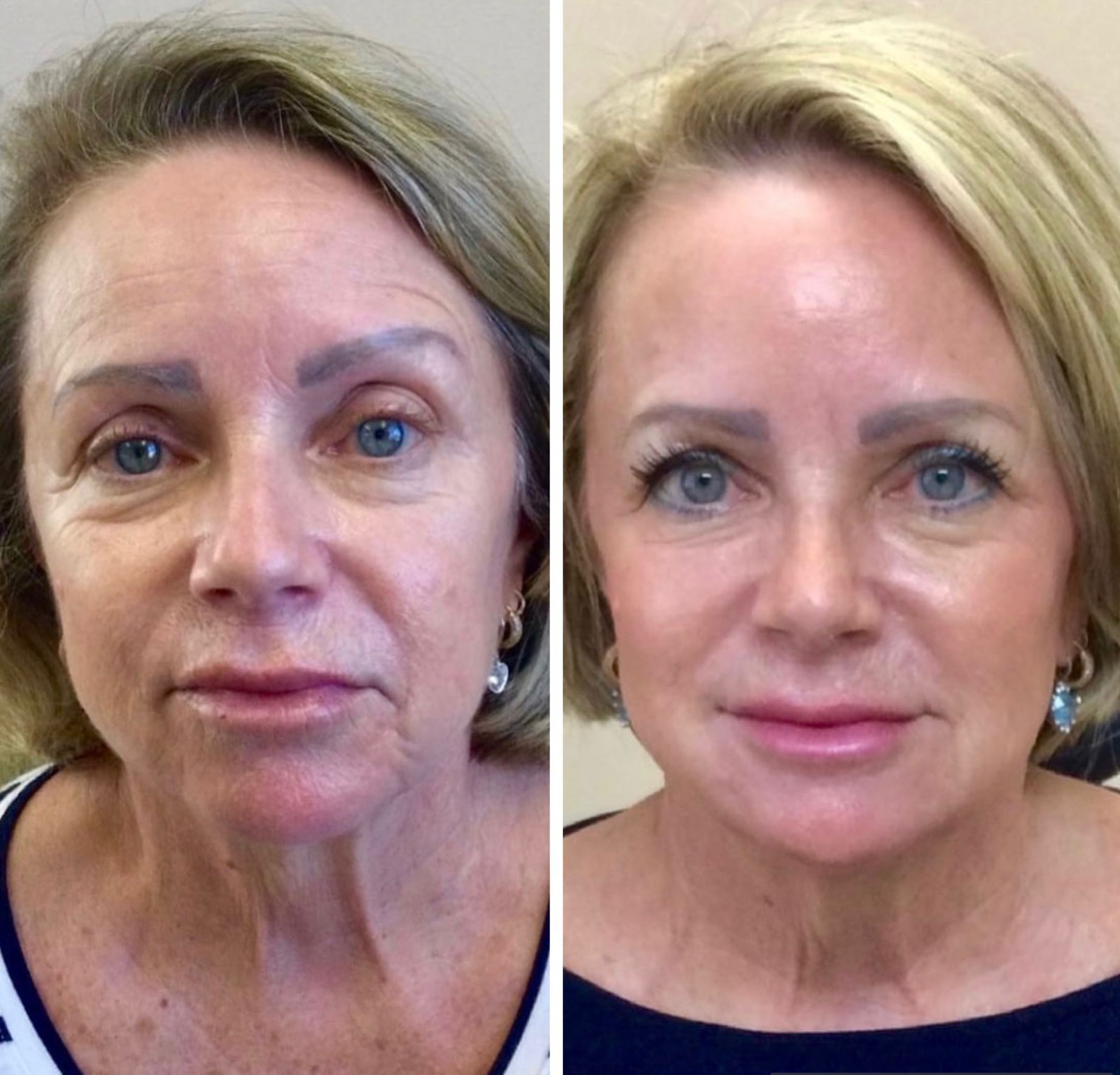 Before and After - Patient result